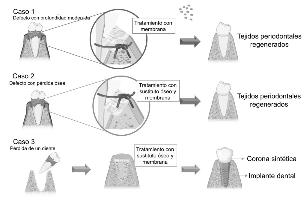 Defectos Instrumentales Biomateriales, aliados indispensables en la regeneración periodontal ...